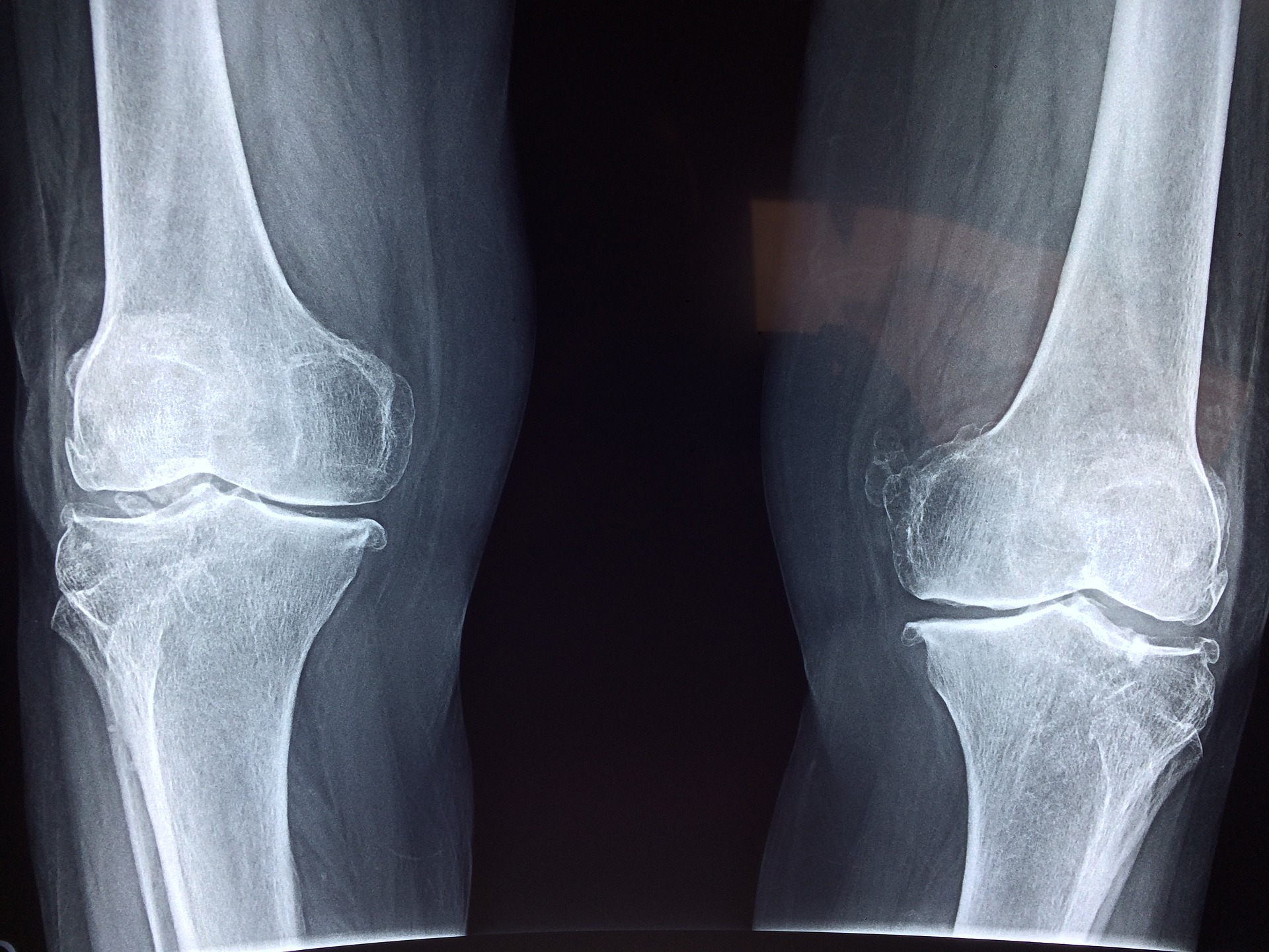 膝の関節は二軸であるため、外側からの外力がかかると組織に傷つけてしまう。