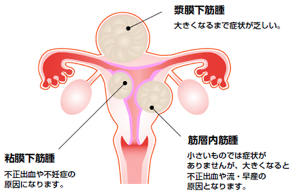 女性がかかる子宮筋腫とは