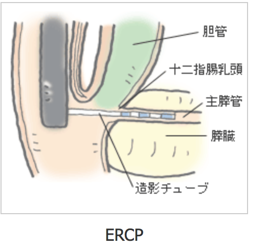 膵臓の検査ERCP