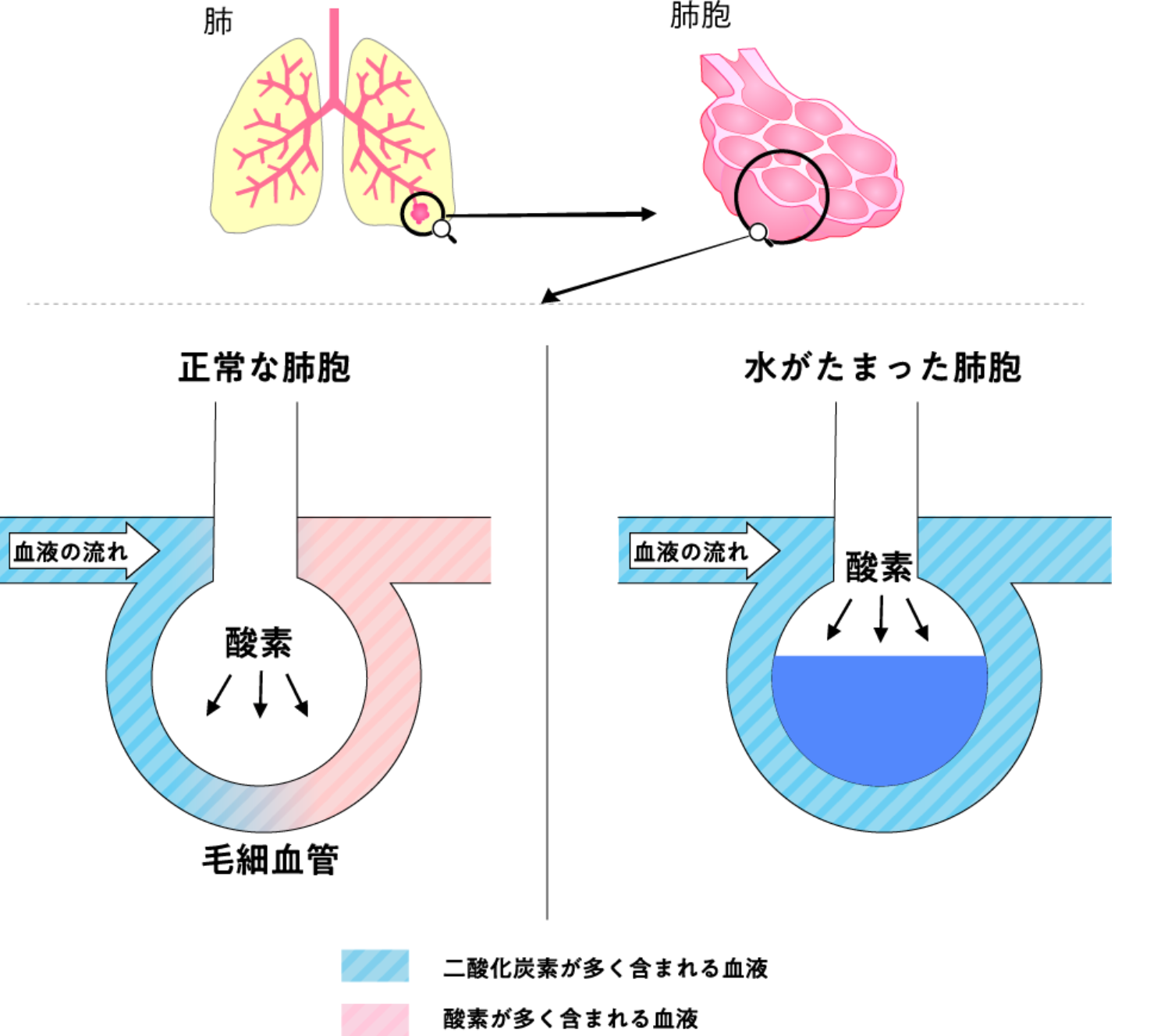 肺水腫の画像